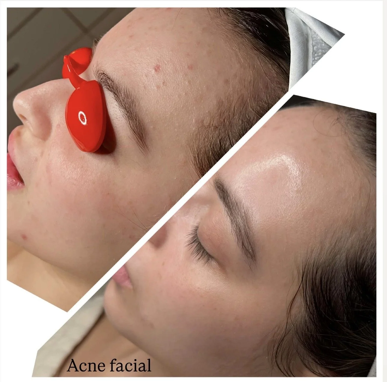 After acne facial