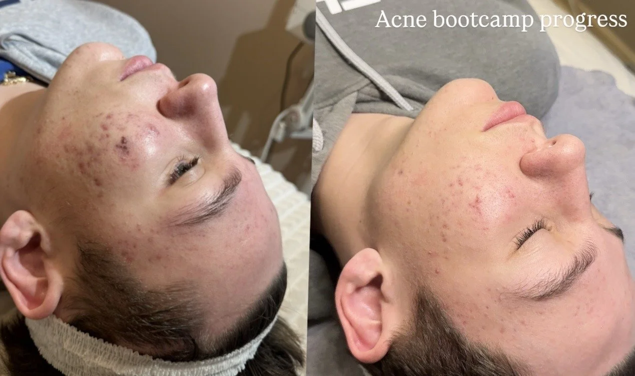 acne bootcamp