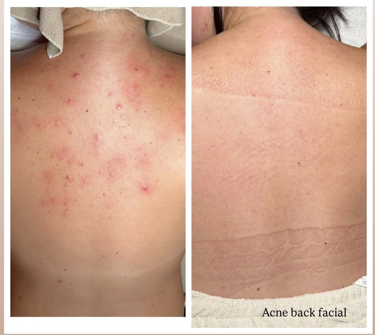 acne back treatment