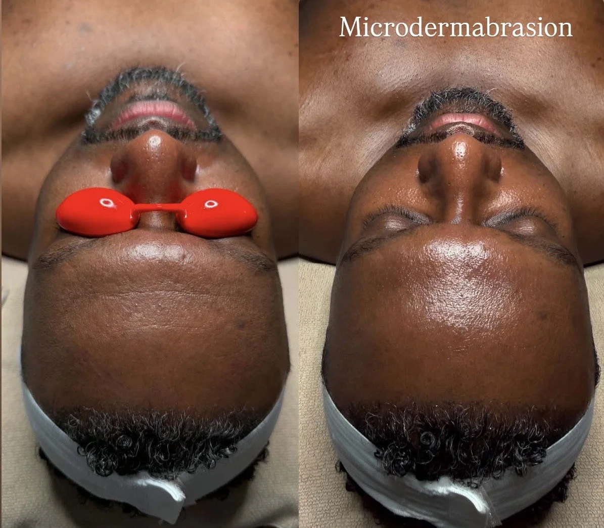 Microdermabrasion