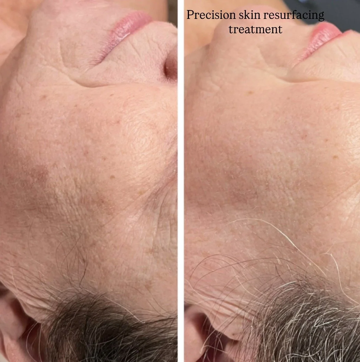 Precision Skin Resurfacing