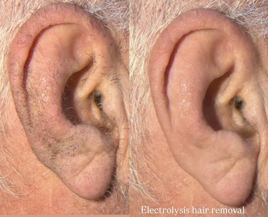 Electrolysis on ear