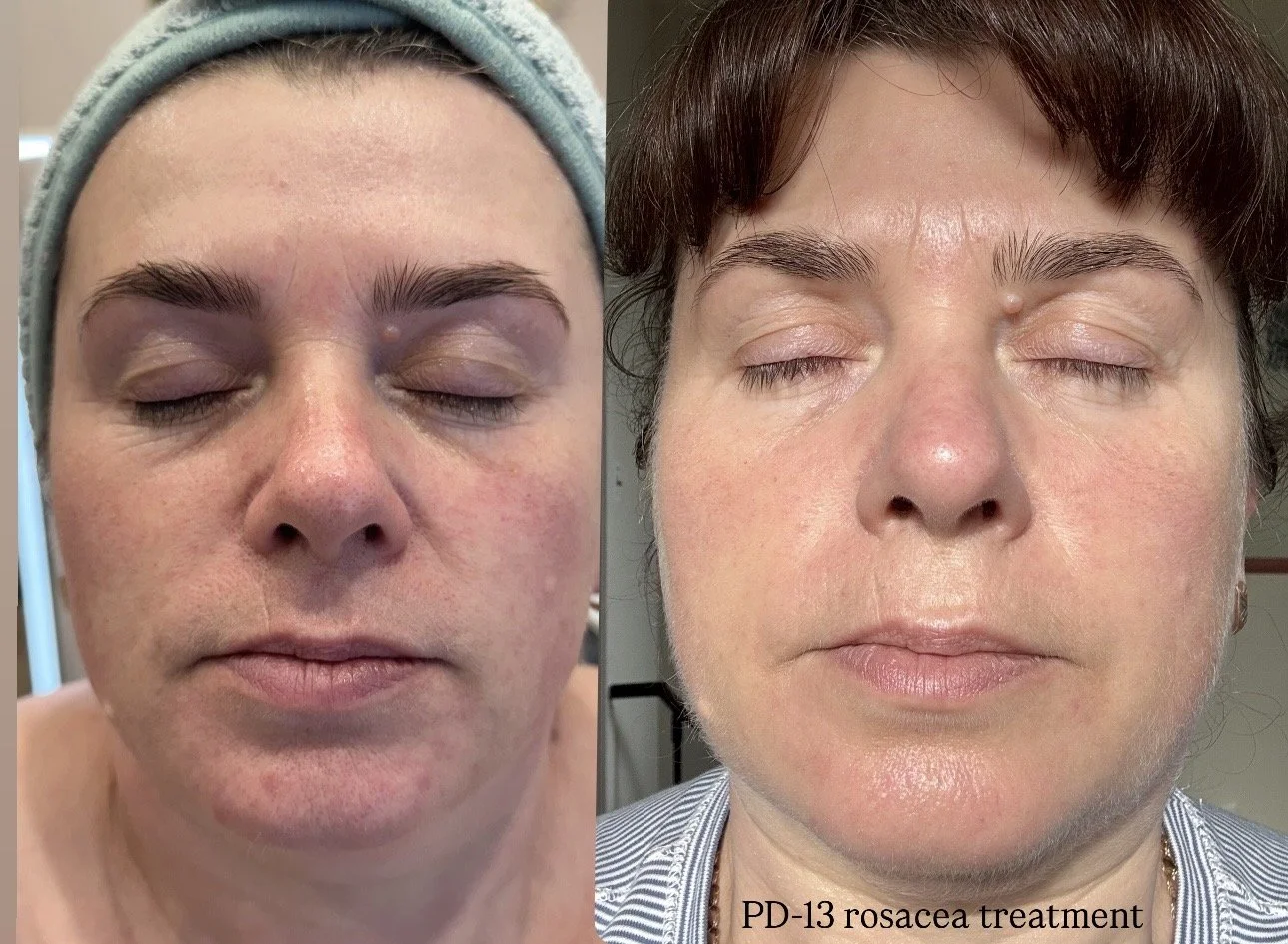 Korean PD13 treatment