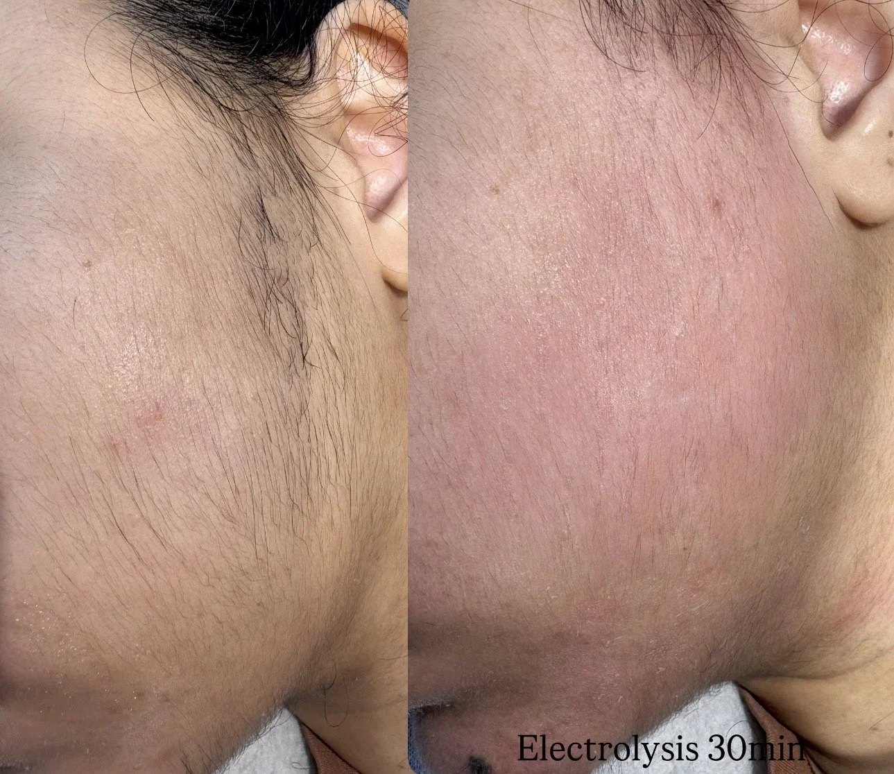Electrolysis 30 min