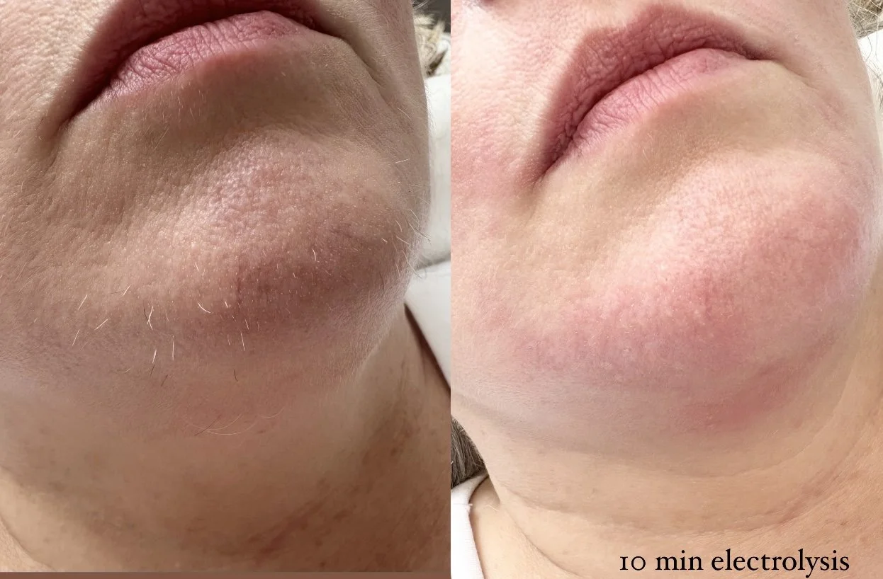 Electrolysis after 10 min