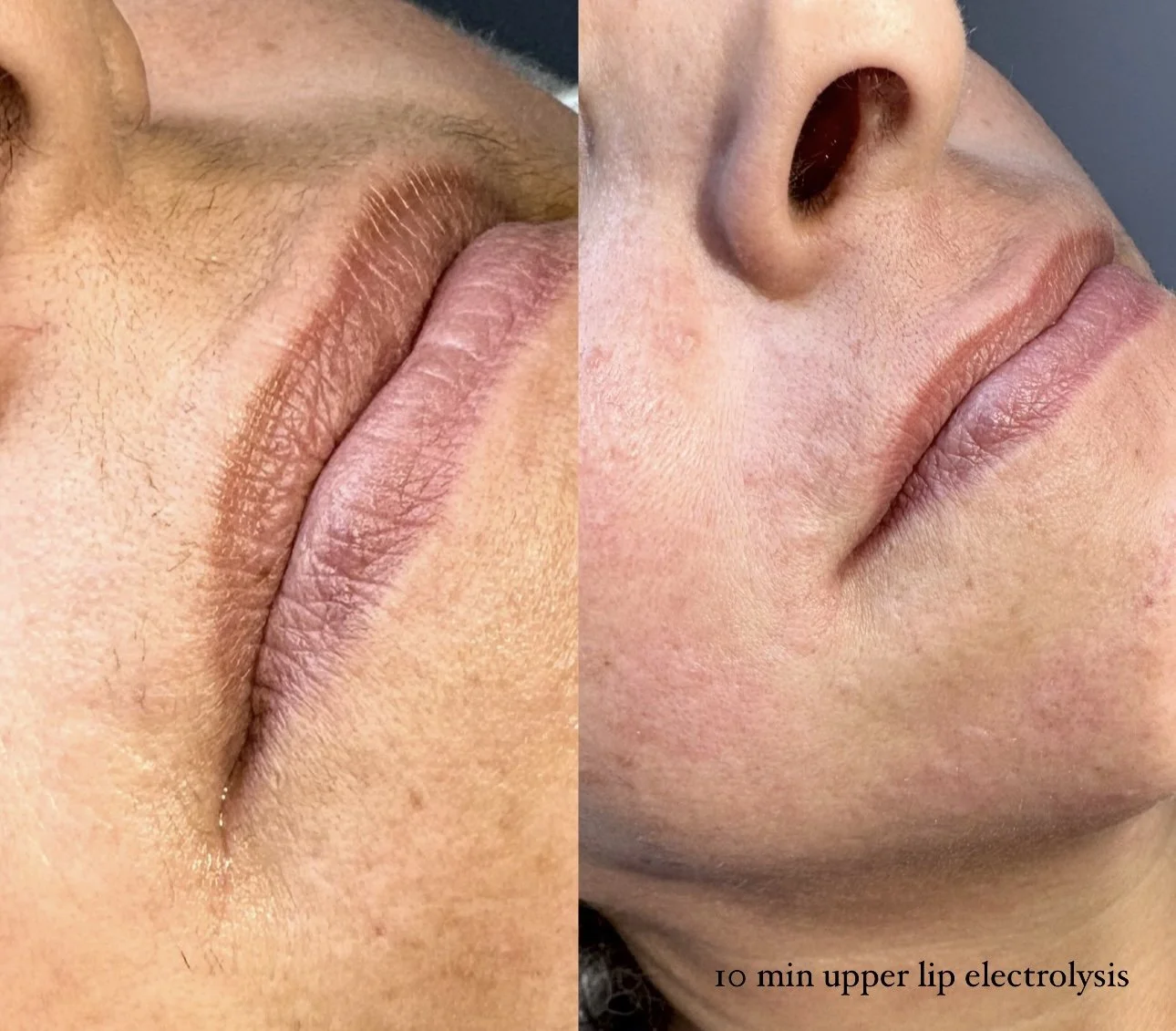 upper lip after 10 min