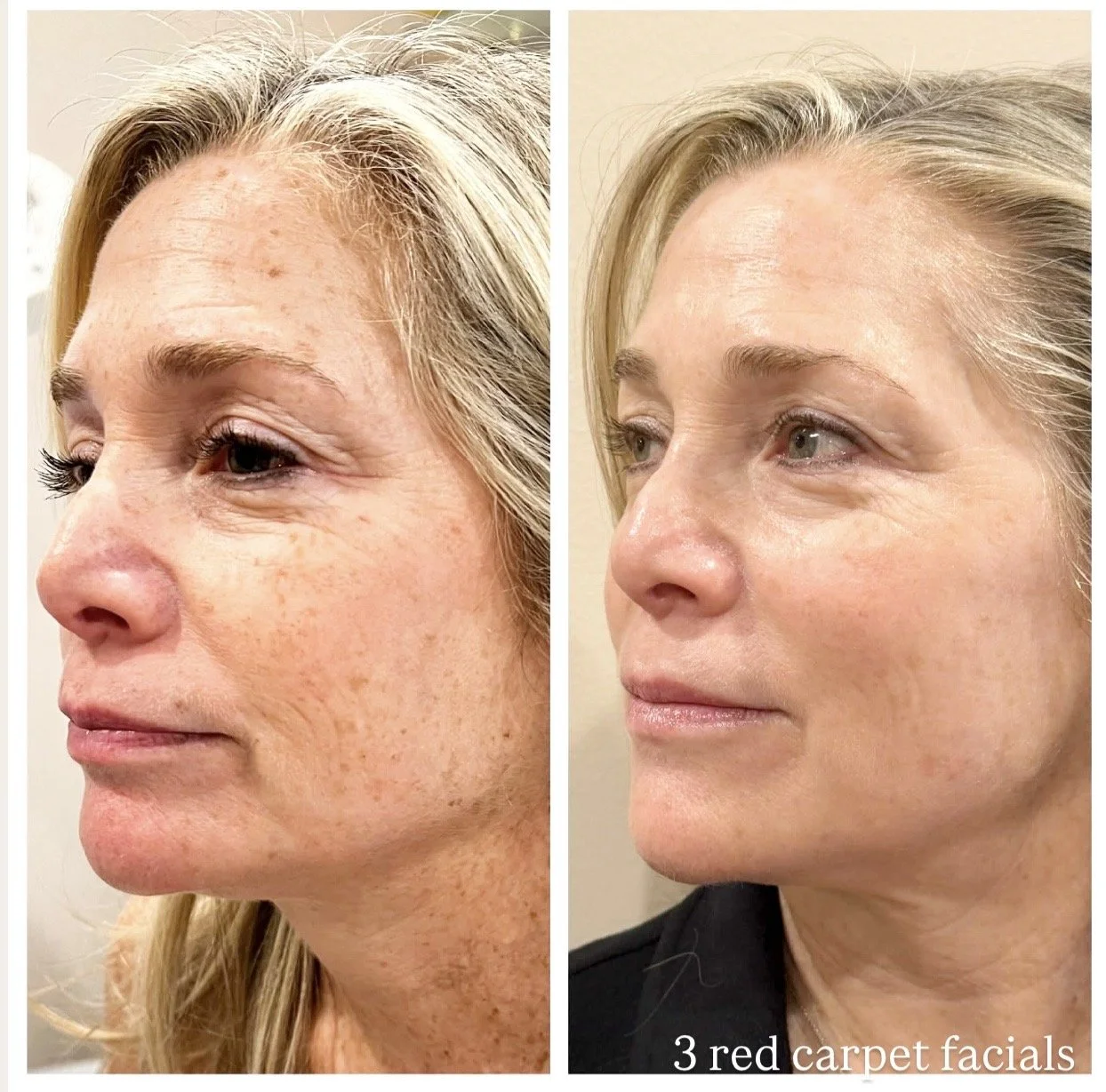 after 3 Red carpet facials
