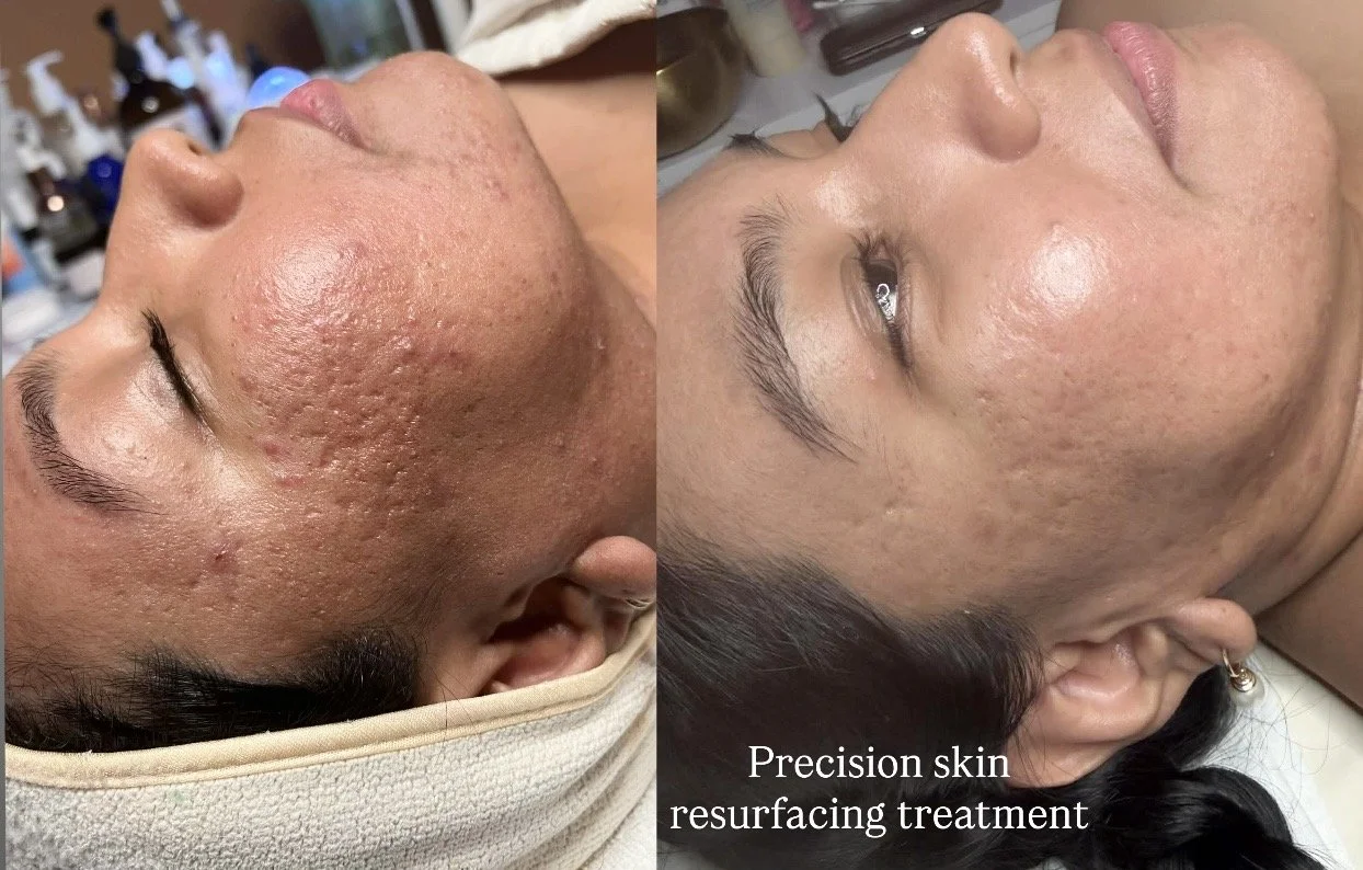 Precision Skin Resurfacing