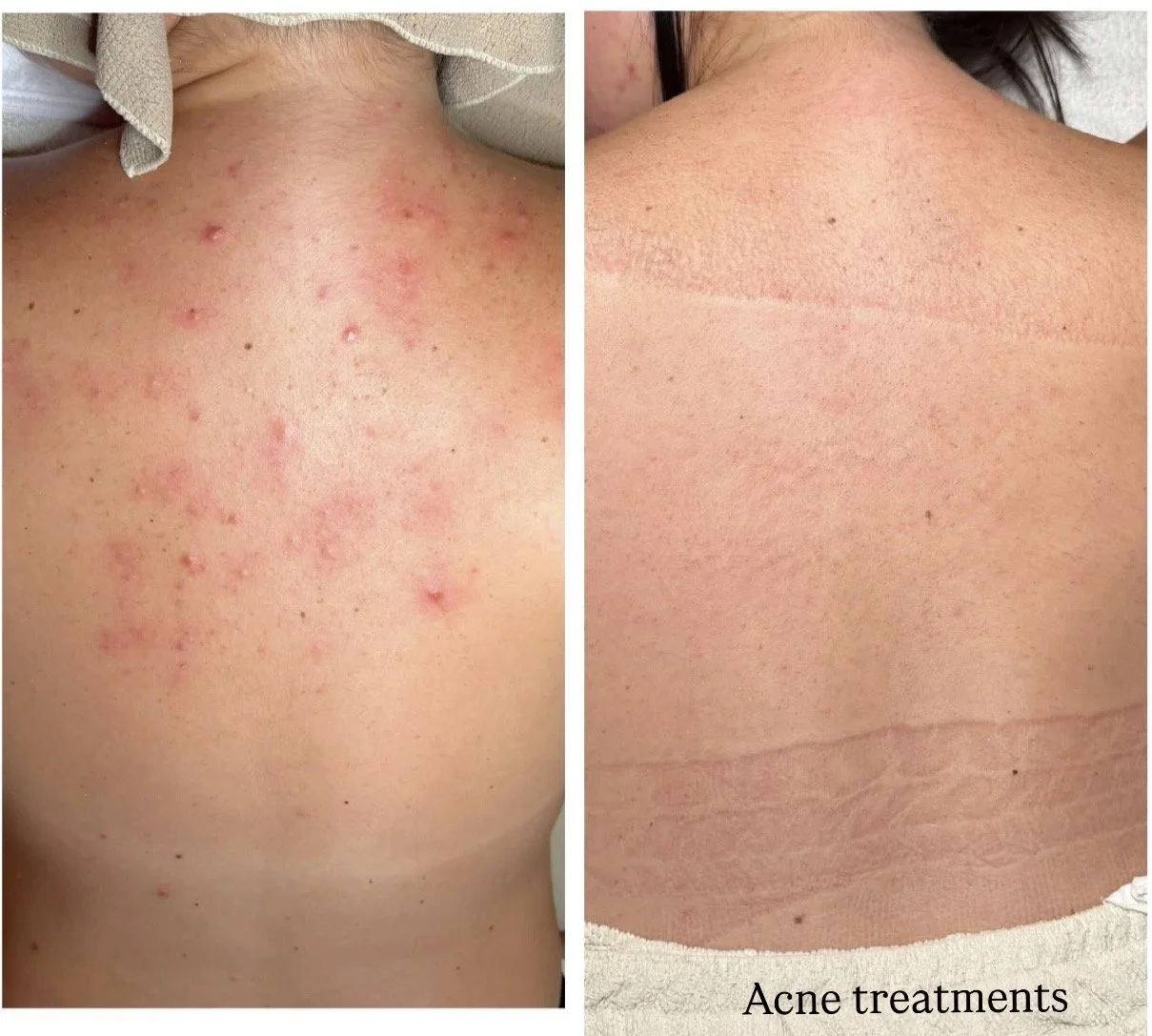 acne back treatment