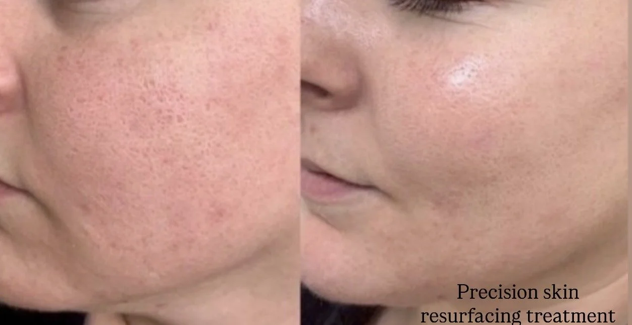 Precision Skin Resurfacing