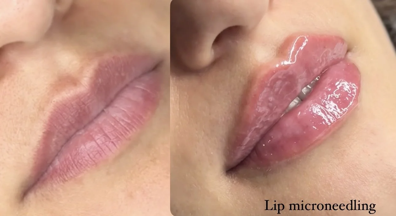 Lip microneedling