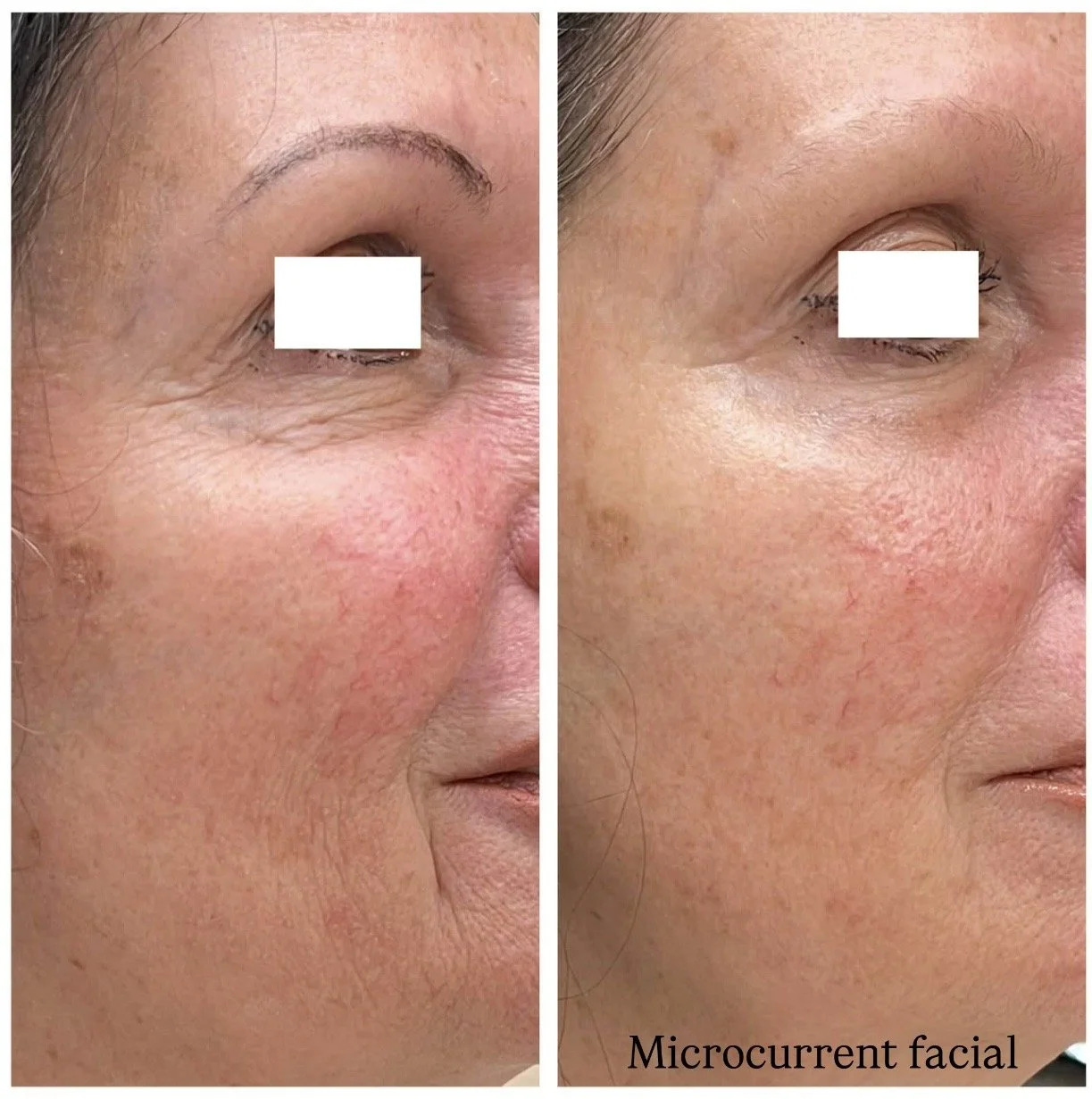 microcurrent facial