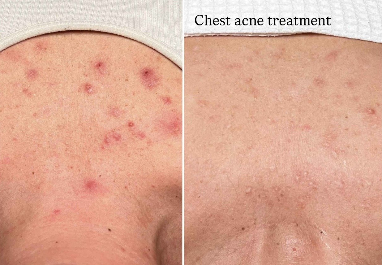 acne chest treatment
