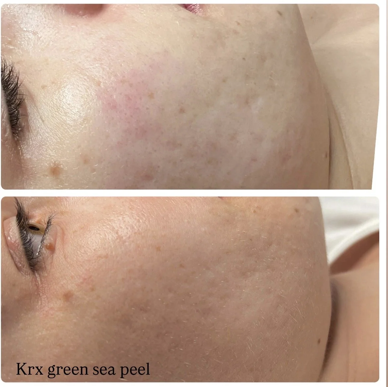 krx green sea peel
