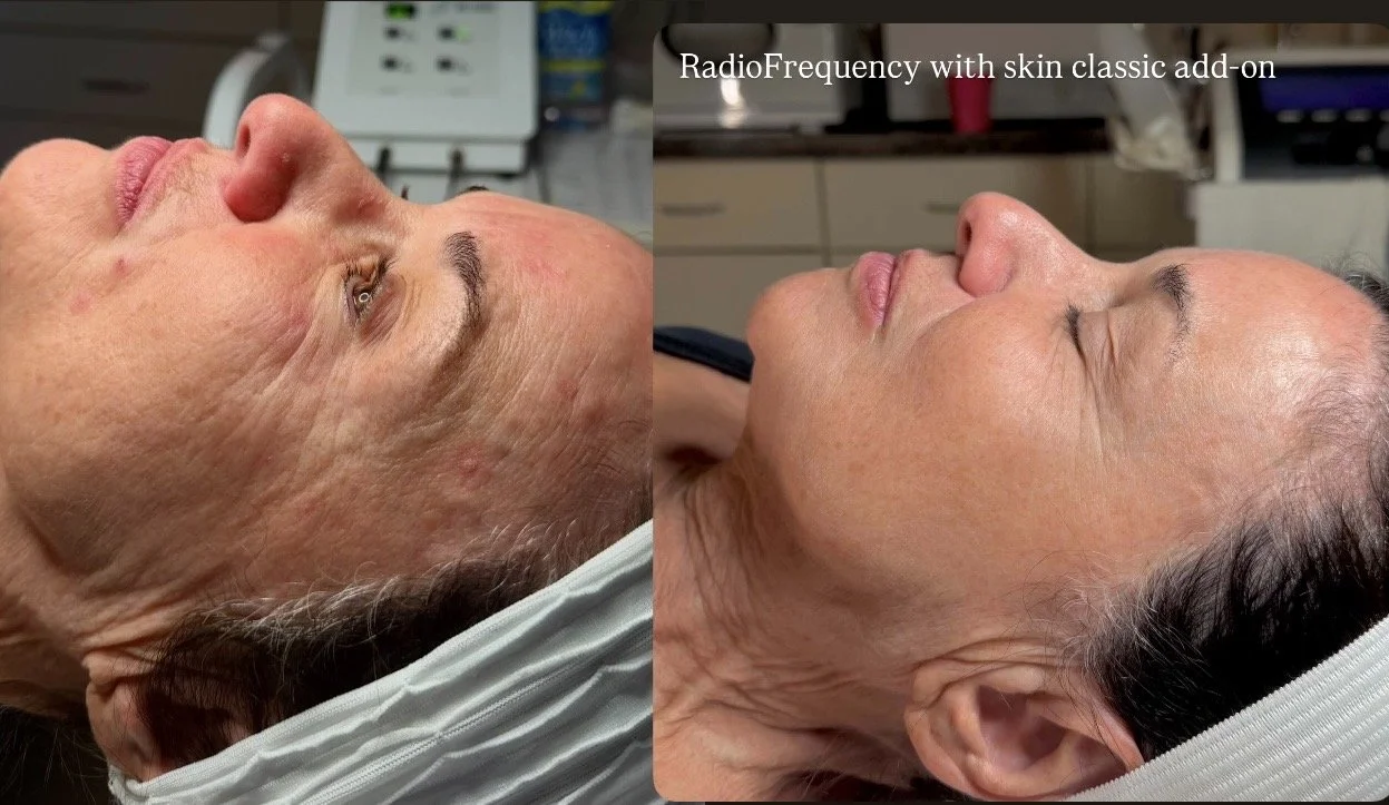 Radiofrequency treatment