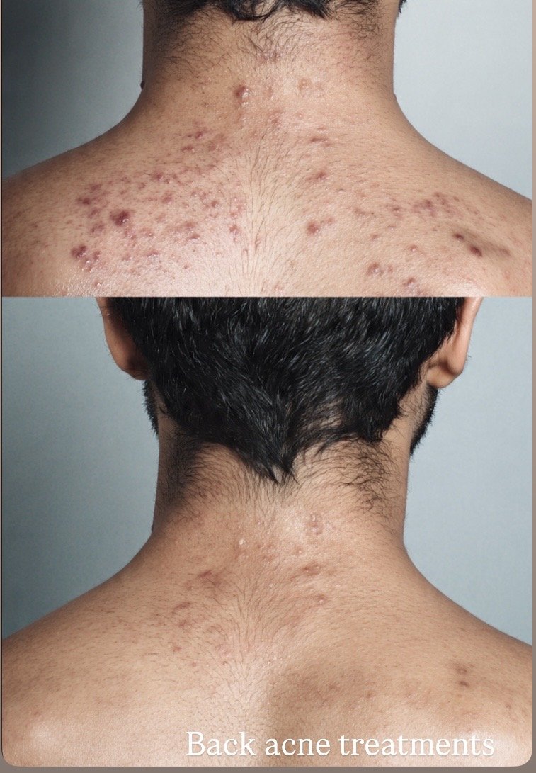 acne back treatment