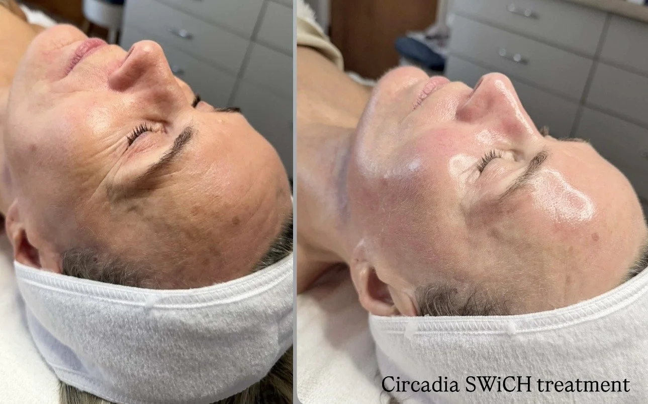 Circadia SWICH peel