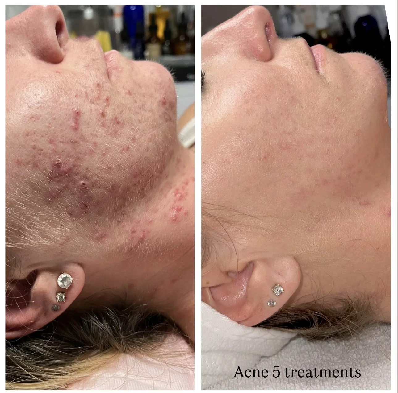 acne after 5 treatment