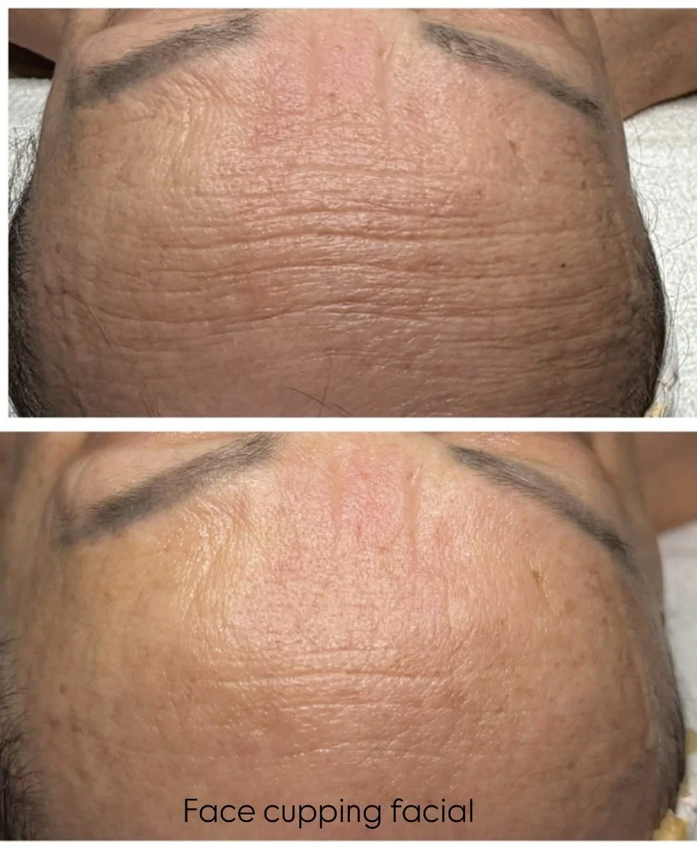 Face cupping facial 