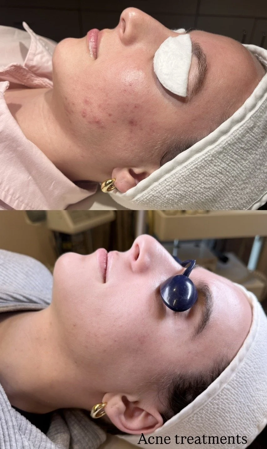 acne facial