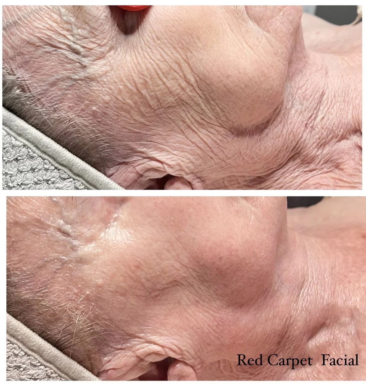 Red Carpet facial
