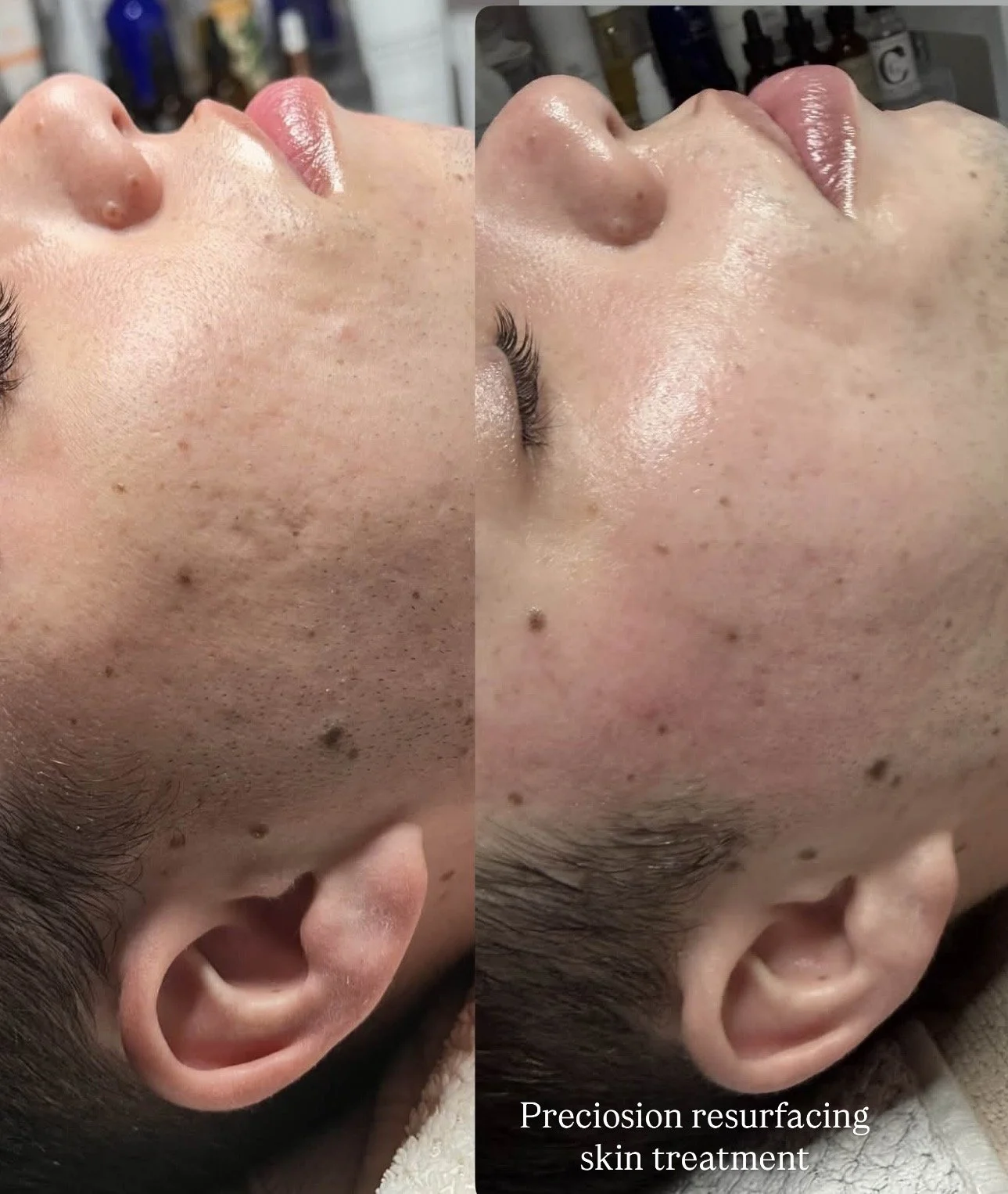 Precision Skin Resurfacing