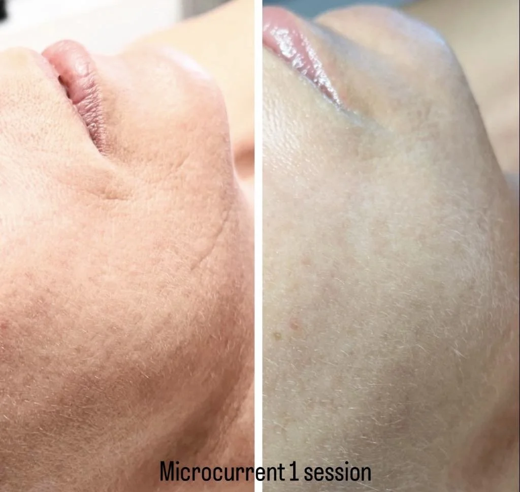 Microcurrent after 1 visit