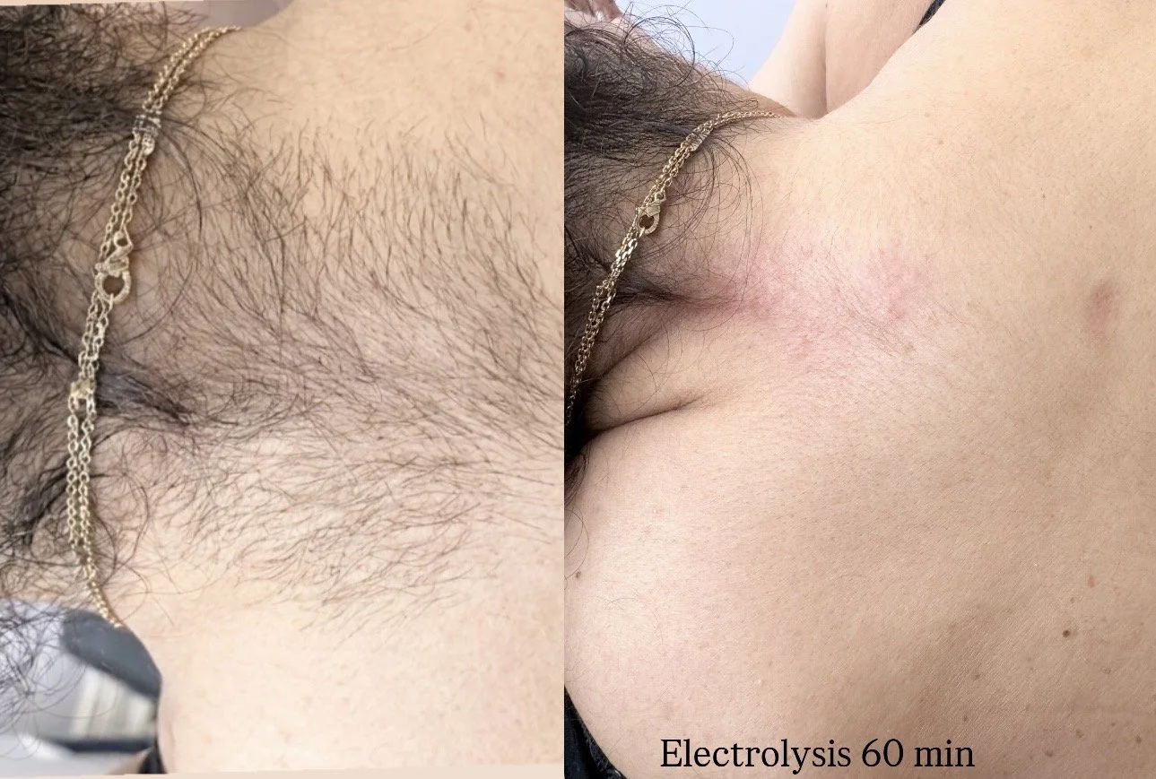 Electrolysis 60 min