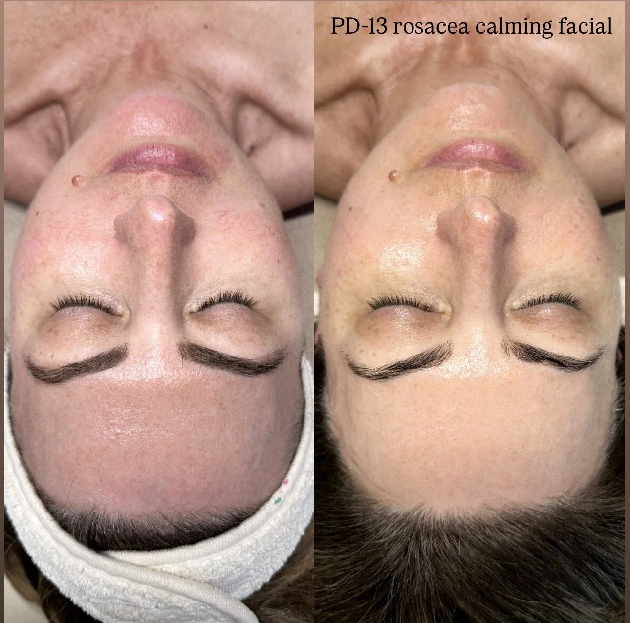 Korean PD13 treatment
