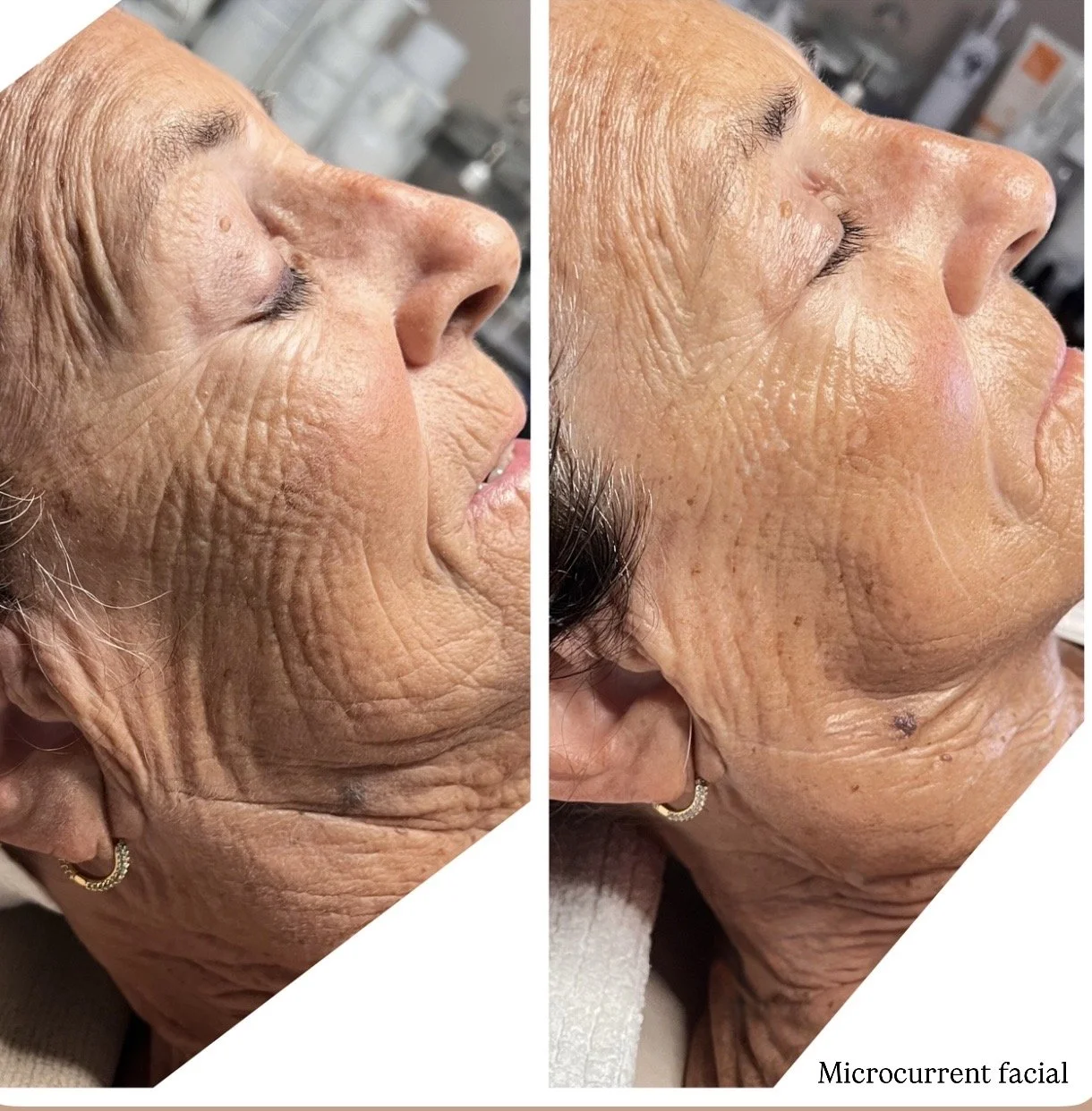 microcurrent facial