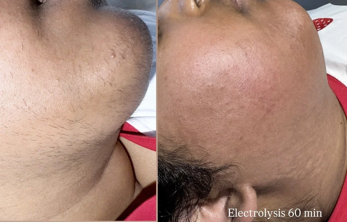 Electrolysis 60 min