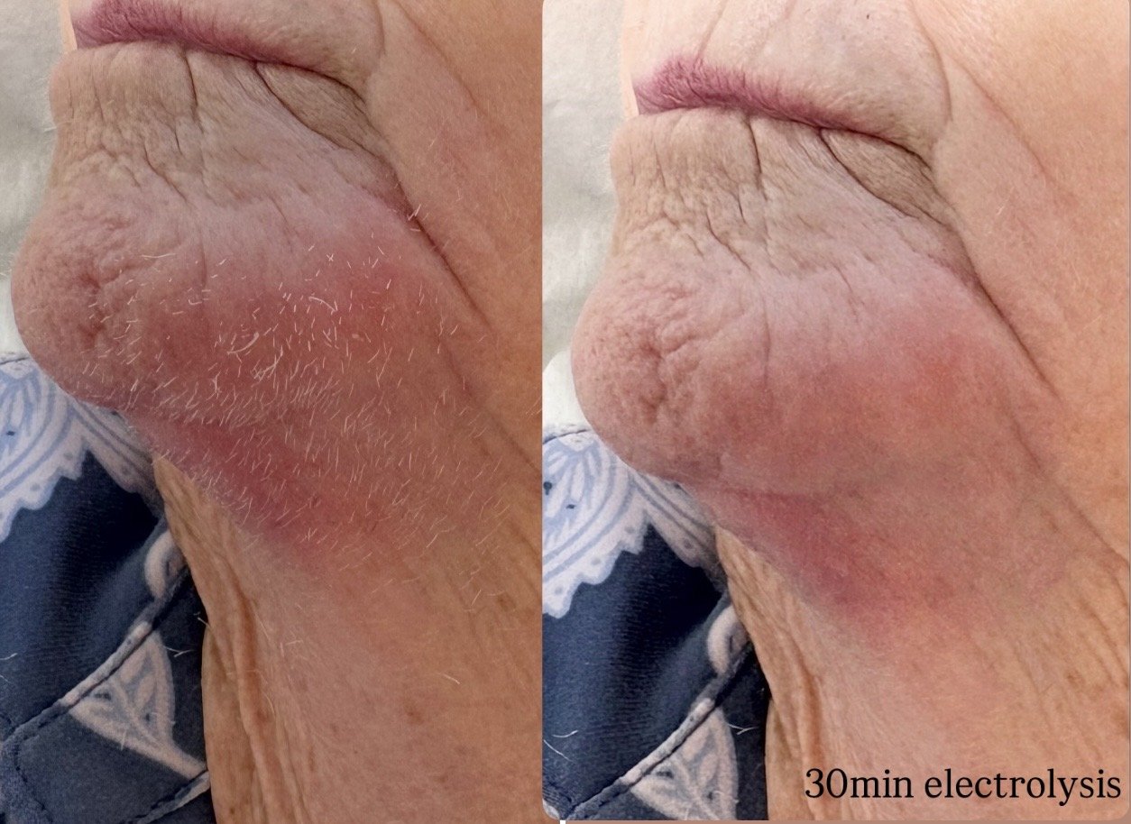Electrolysis 30 min