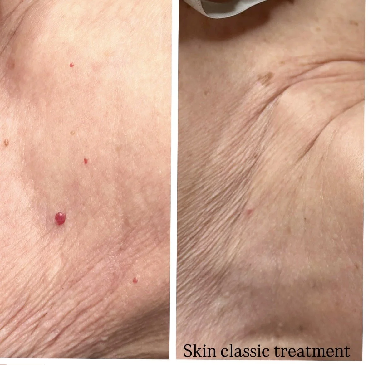skin classic
