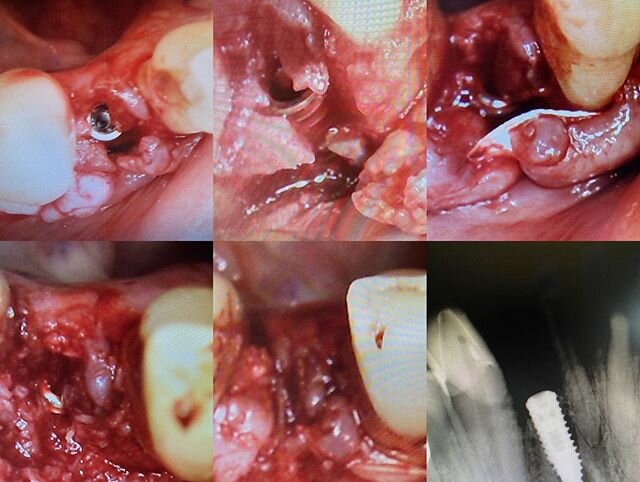 The second #26 emergency. #26 fractured, this tooth was facially malpositioned and patient had previously RCT and crown the tooth for better esthetics and alignment. Immediate implant placed at 30NcM, due to the original tooth root position, no bucca