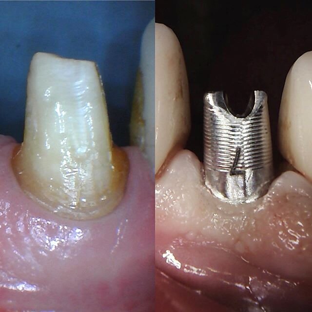 My prep #8 and #7 custom titanium abutment on the same patient 🥰🤤