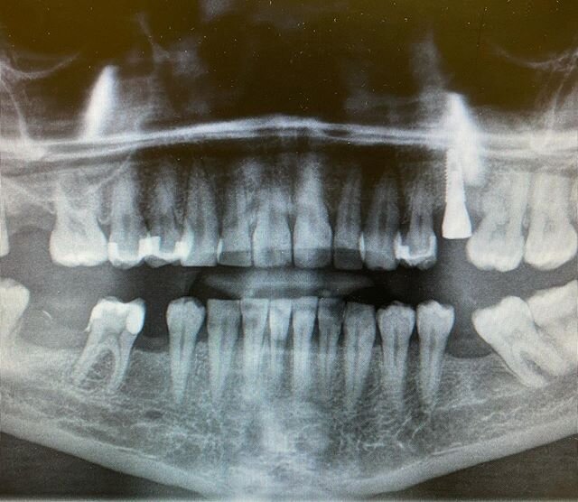 Busy Saturday! Swipe to see before ➡️ Caries control, removed some root tips, placed an implant ✌🏼 (there&rsquo;s actually more space than on the pano, will disc the adjacent teeth and fillings when restoring with a nice custom abutment :)