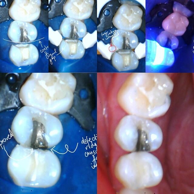 Lots of images today! Inspired by @dr.patrick.calalang and @torculas.dds recent posts and use of #rubberdam
Repair of an existing #12DO resin
I think it&rsquo;s important to ask patients many probing questions and be very thorough in your exam. Check