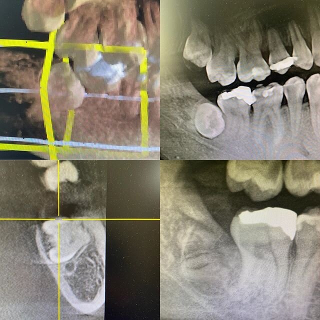 Did a coronectomy on this complete bony lingually and horizontally impacted #32. 
I chose to do coronectomy because the roots were nestled way buccally and had no movement at all after taking off the crown of the tooth. There was more than 3mm of Bon