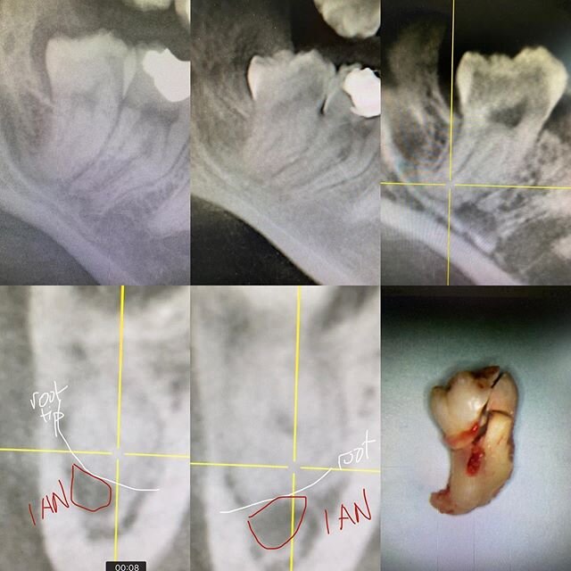 &lsquo;Tis the season for wisdom teeth. 
This patient complained off on/off throbbing of her wisdom teeth. A pano was taken and it looked like there was significant involvement of #32 Root tips with IAN. Luckily we also have in-house CBCT, after thor