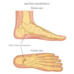 Chronic Heel Pain; Is it Baxter’s Nerve Entrapment? — Back To Back ...