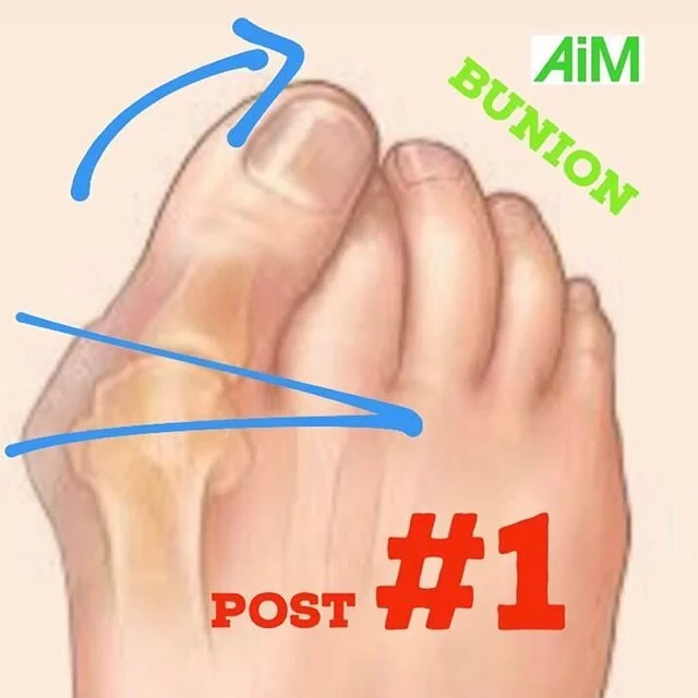 A guest blog by Gary Ward on bunions