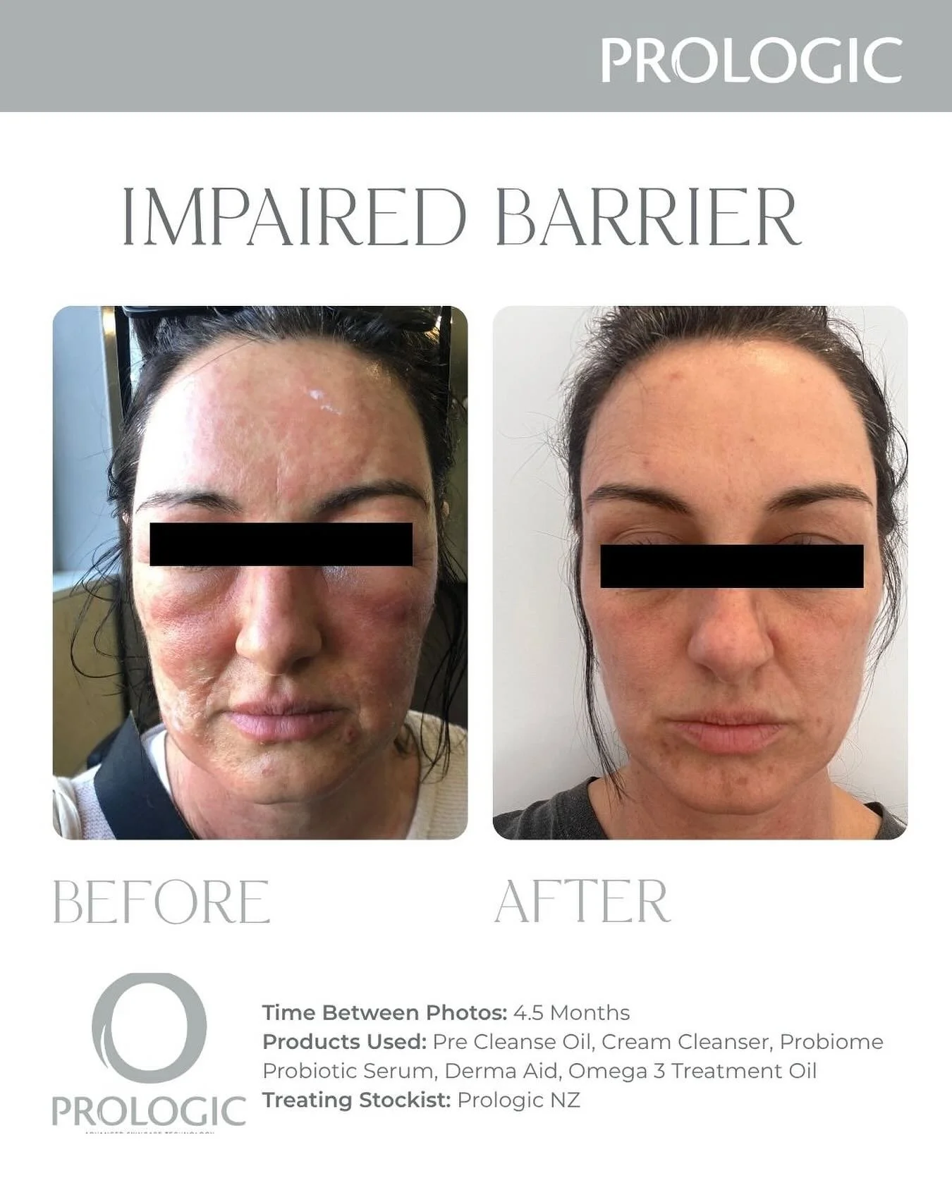 Skin Transformation Journey

This beautiful client came to us after experiencing a severe reaction to a topical product applied following a clinical treatment, not performed at a Prologic clinic and not using Prologic products.

The reaction caused i