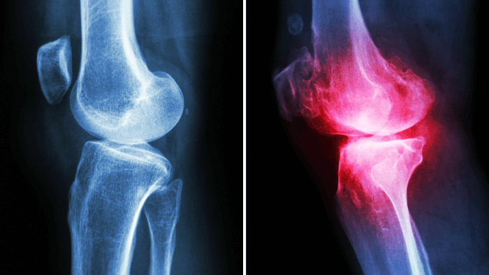 normal knee joint x-ray in comparison to knee joint with osteoarthritis