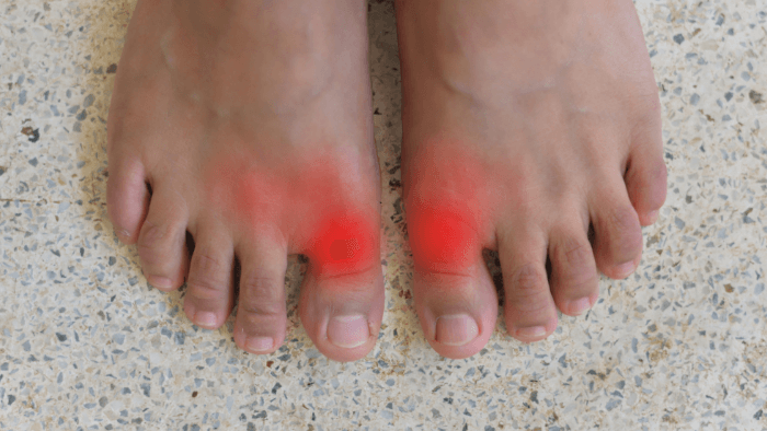 gout arthritis in toes highlighted in red