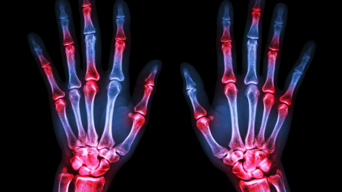 x-ray of two hands with red spots over the joints indicating arthritis