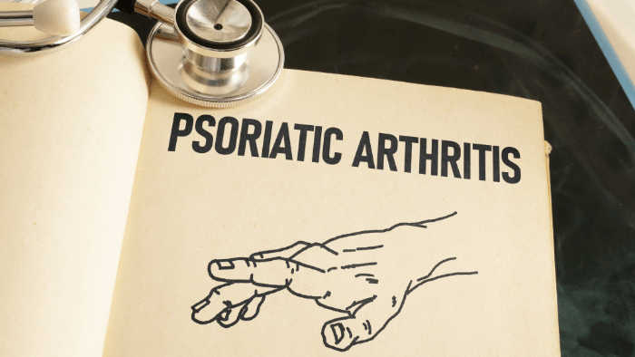 drawing of hand with psoriatic arthritis