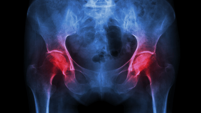 hip joint x-ray showing osteoarthritis