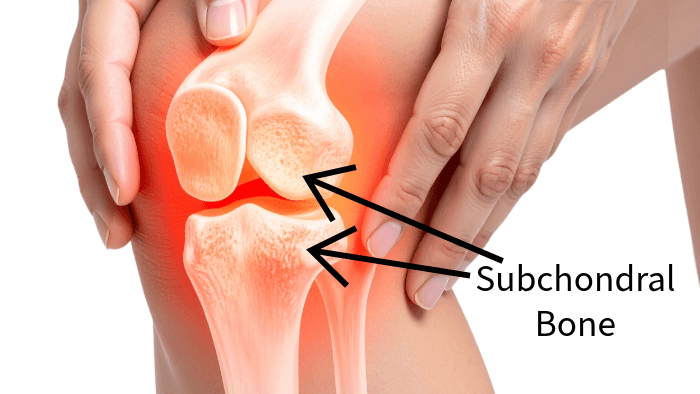 image of knee joint with arrows pointing to subchondral bone