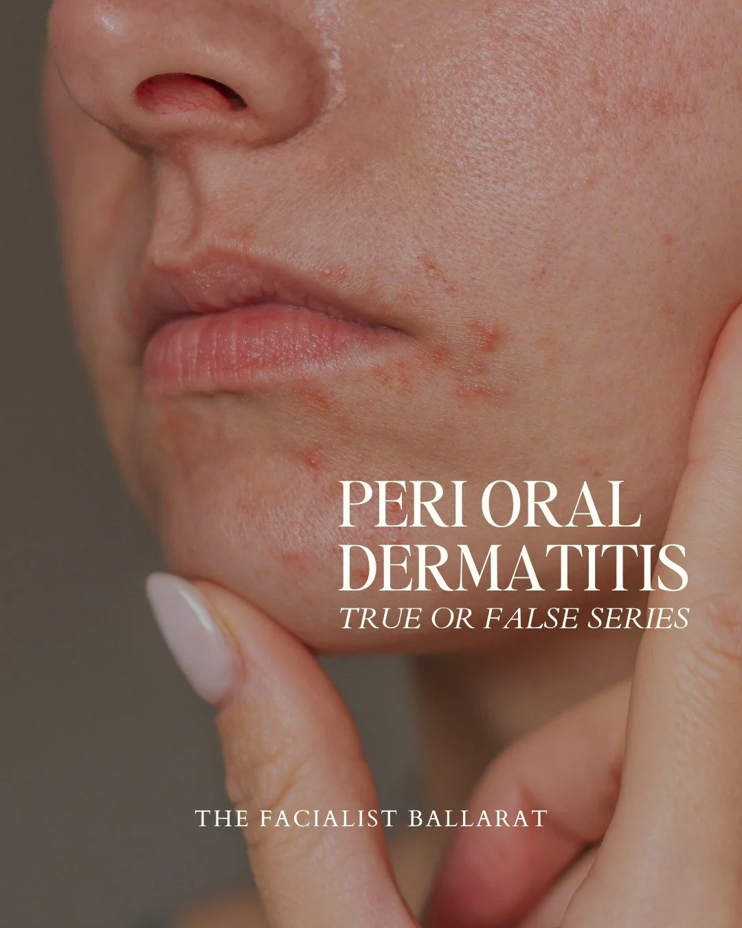 Peri Oral Dermatitis is difficult, I know I am currently dealing with it! 

If you struggle with recurring POD or you&rsquo;re having your first experience with it. Book a skin consultation with us for a tailored approach that actually works with you