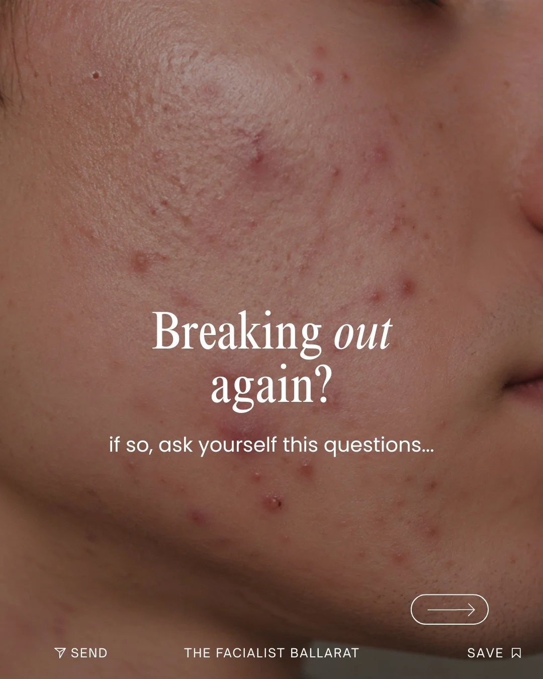 There are no quick fixes when dealing with acne.

We believe in supporting the skin&rsquo;s natural function and creating sustainable change over time.

Patience and commitment lead to healthy, long lasting results.

Booking Link In Bio